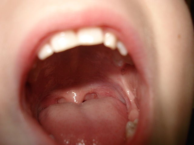 Tumori di bocca e collo: successi al 90% ma solo se la diagnosi è precoce
